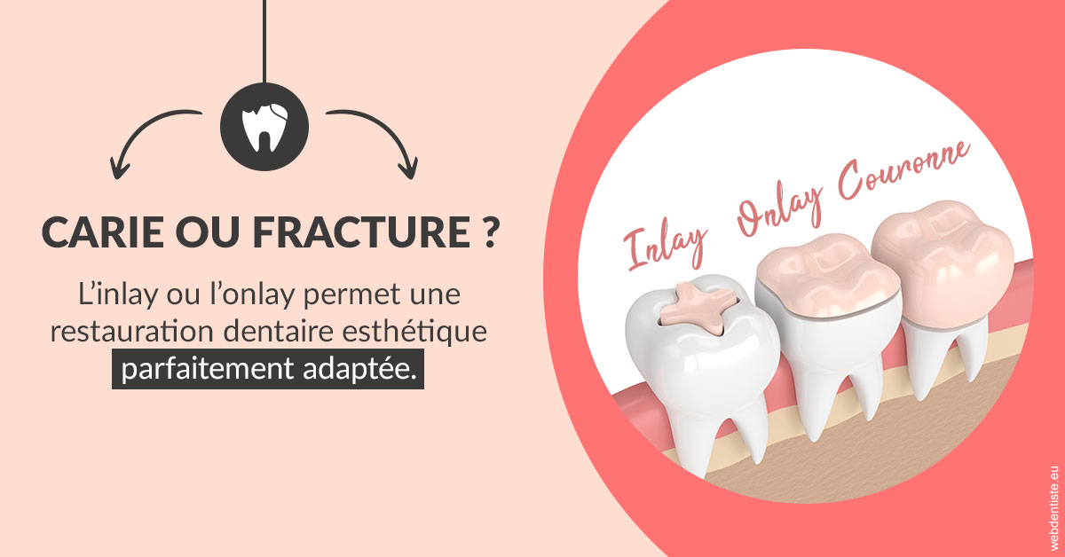 https://dr-bulthe-pierre.chirurgiens-dentistes.fr/T2 2023 - Carie ou fracture 2