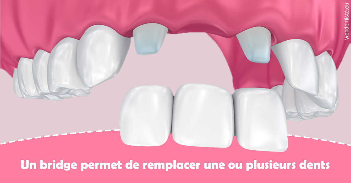 https://dr-bulthe-pierre.chirurgiens-dentistes.fr/Bridge remplacer dents 2