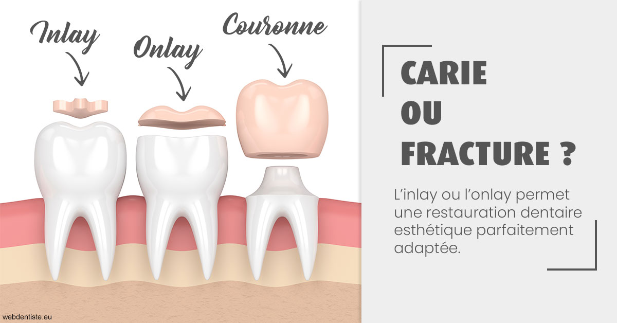 https://dr-bulthe-pierre.chirurgiens-dentistes.fr/T2 2023 - Carie ou fracture 1