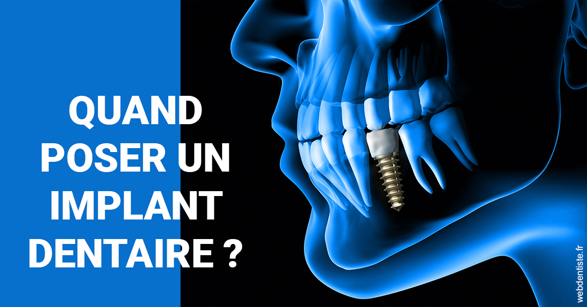 https://dr-bulthe-pierre.chirurgiens-dentistes.fr/Les implants 1