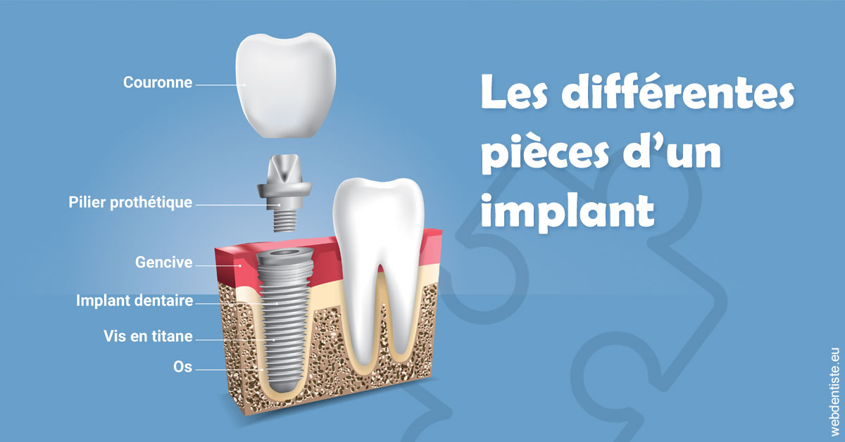 https://dr-bulthe-pierre.chirurgiens-dentistes.fr/Les différentes pièces d’un implant 1